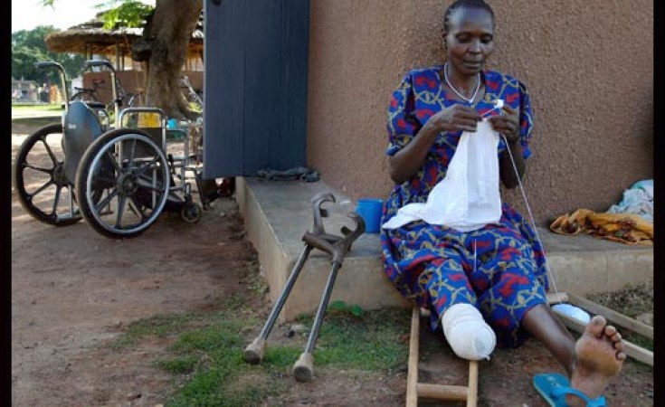 Africa: Cross-Sectional Study Spotlights Unnerving Findings On Phantom Limb Pain